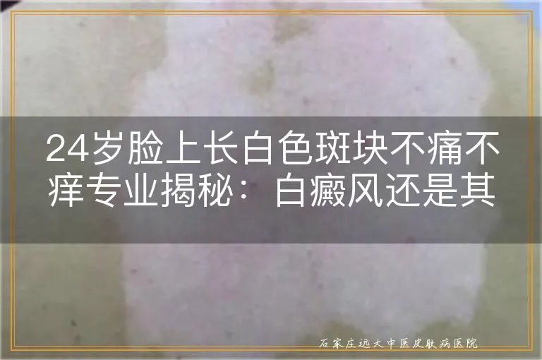 24岁脸上长白色斑块不痛不痒专业揭秘：白癜风还是其他皮肤问题