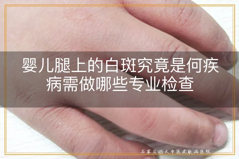 婴儿腿上的白斑究竟是何疾病需做哪些专业检查