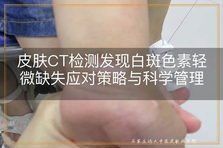 皮肤CT检测发现白斑色素轻微缺失应对策略与科学管理