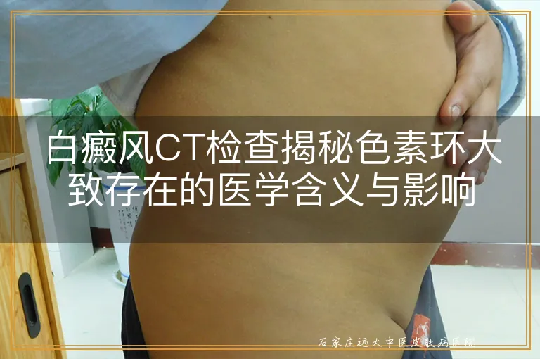 白癜风CT检查揭秘色素环大致存在的医学含义与影响