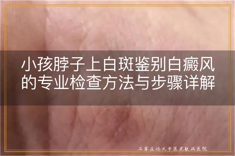 小孩脖子上白斑鉴别白癜风的专业检查方法与步骤详解