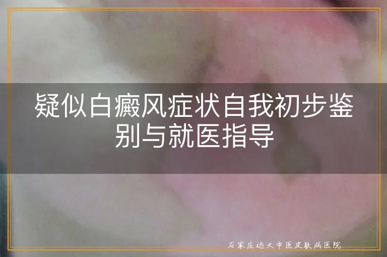 疑似白癜风症状自我初步鉴别与就医指导