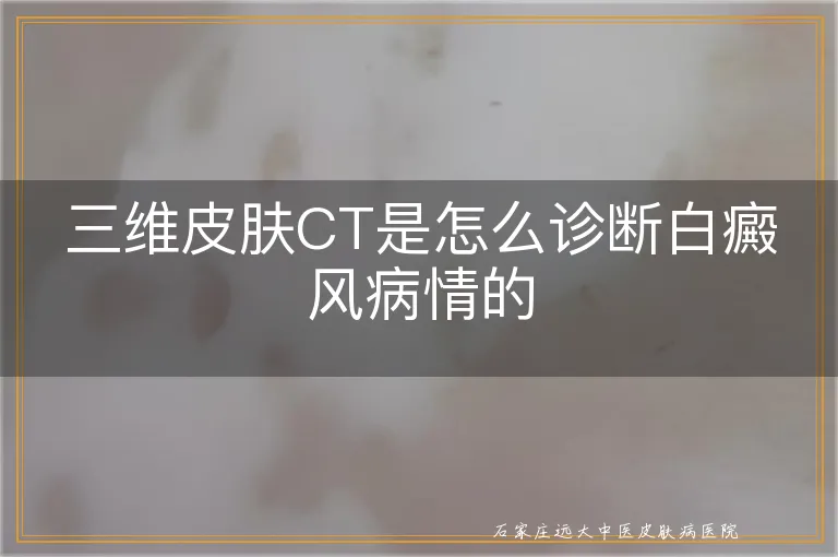 三维皮肤CT是怎么诊断白癜风病情的