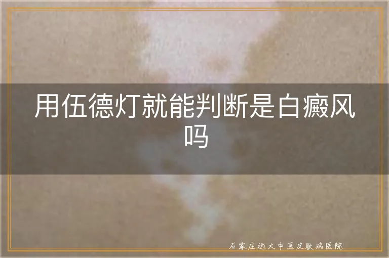 用伍德灯就能判断是白癜风吗