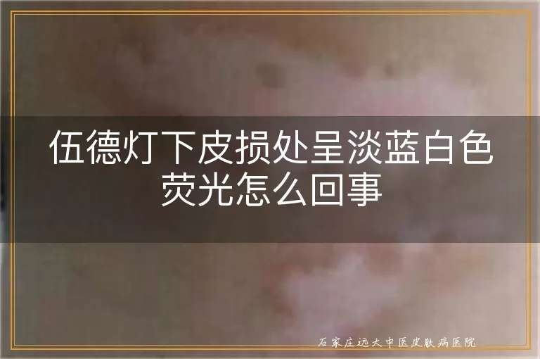 伍德灯下皮损处呈淡蓝白色荧光怎么回事