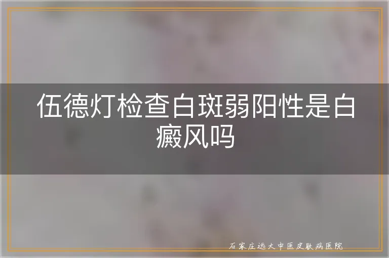 伍德灯检查白斑弱阳性是白癜风吗