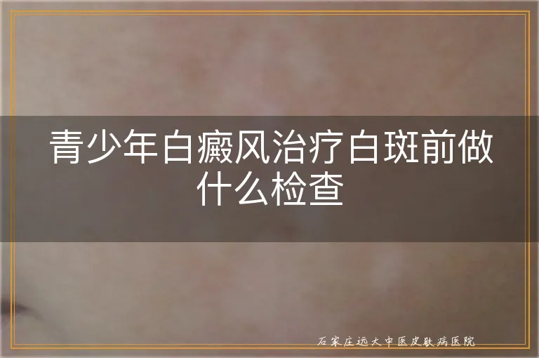 青少年白癜风治疗白斑前做什么检查