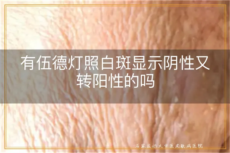 有伍德灯照白斑显示阴性又转阳性的吗