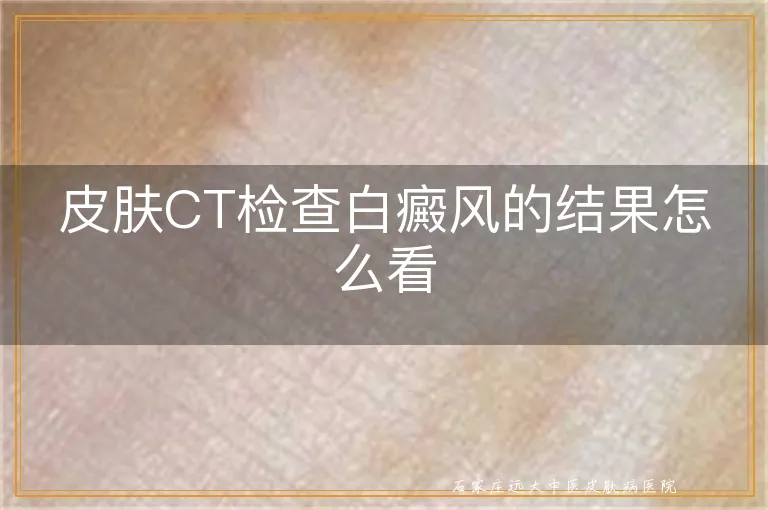 皮肤CT检查白癜风的结果怎么看