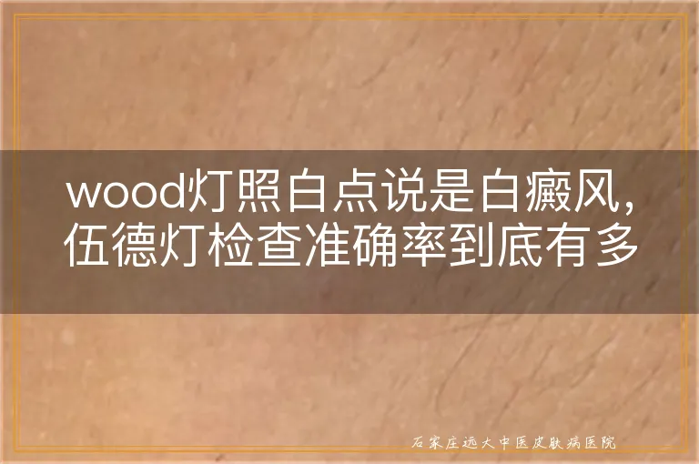 wood灯照白点说是白癜风，伍德灯检查准确率到底有多少？