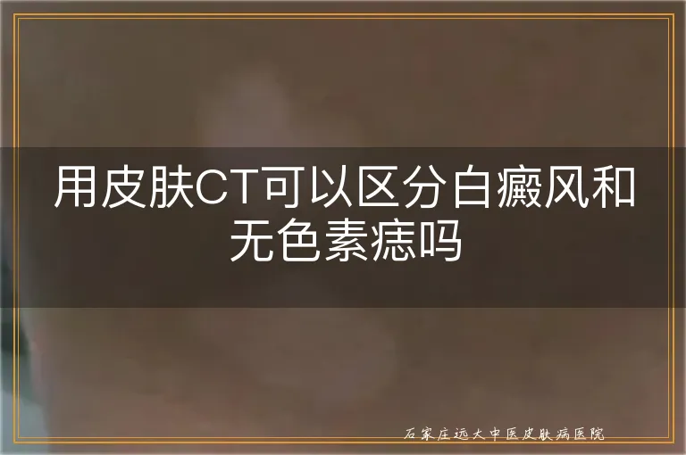 用皮肤CT可以区分白癜风和无色素痣吗