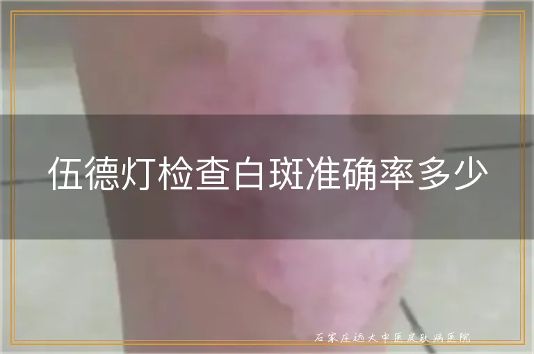 伍德灯检查白斑准确率多少