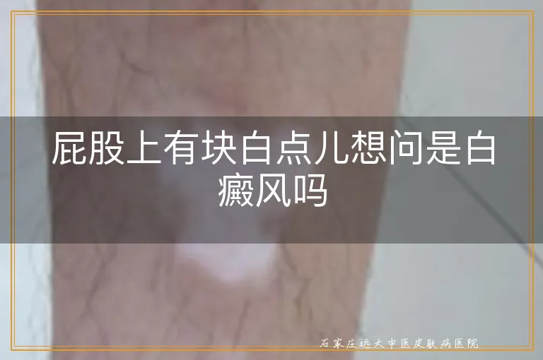 屁股上有块白点儿想问是白癜风吗