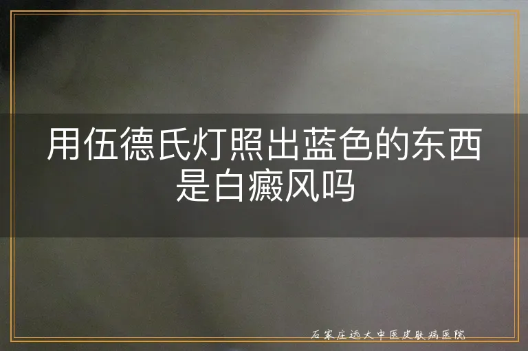 用伍德氏灯照出蓝色的东西是白癜风吗