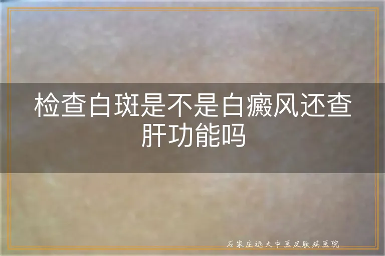 检查白斑是不是白癜风还查肝功能吗