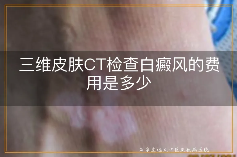 三维皮肤CT检查白癜风的费用是多少