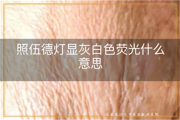 照伍德灯显灰白色荧光什么意思