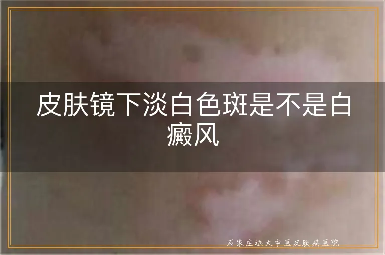 皮肤镜下淡白色斑是不是白癜风