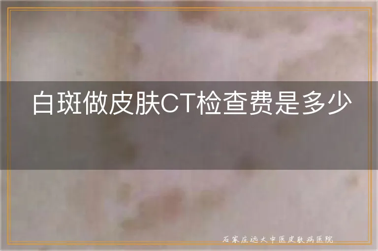 白斑做皮肤CT检查费是多少