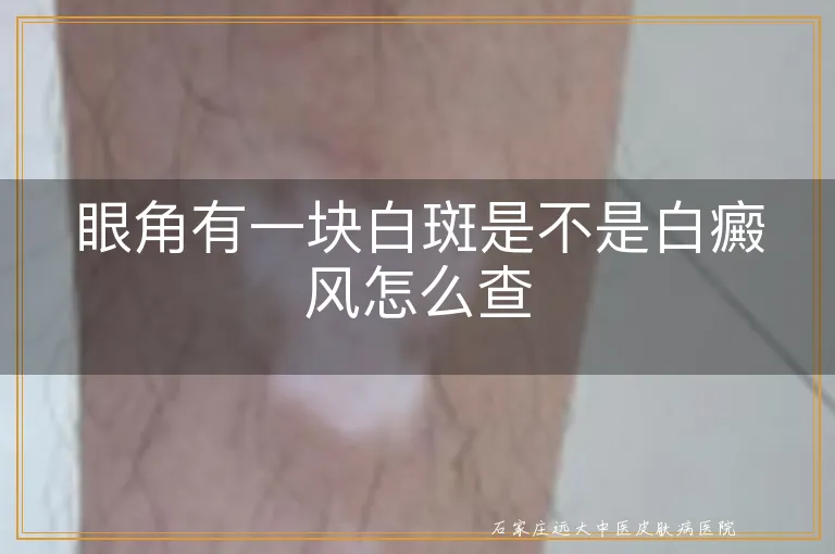 眼角有一块白斑是不是白癜风怎么查