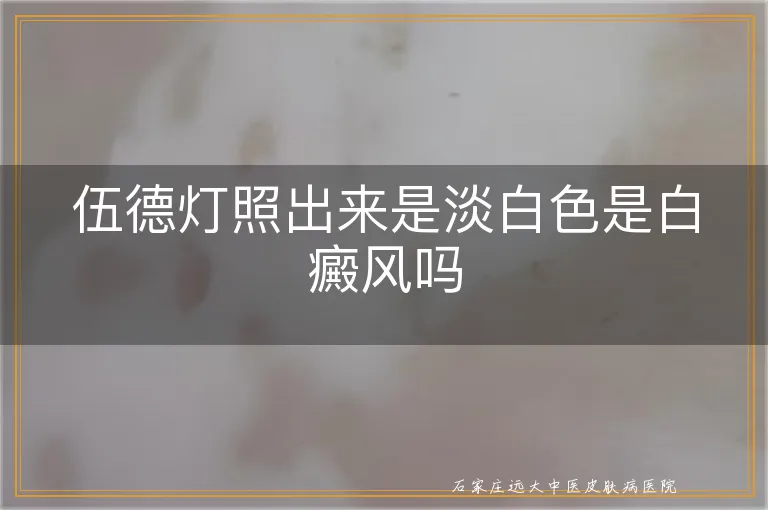 伍德灯照出来是淡白色是白癜风吗