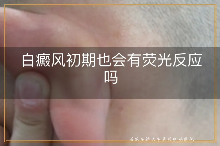 白癜风初期也会有荧光反应吗