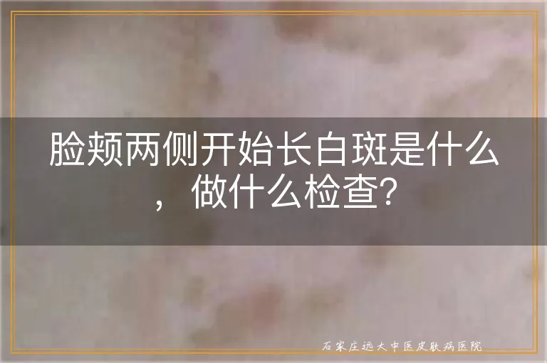 脸颊两侧开始长白斑是什么，做什么检查？