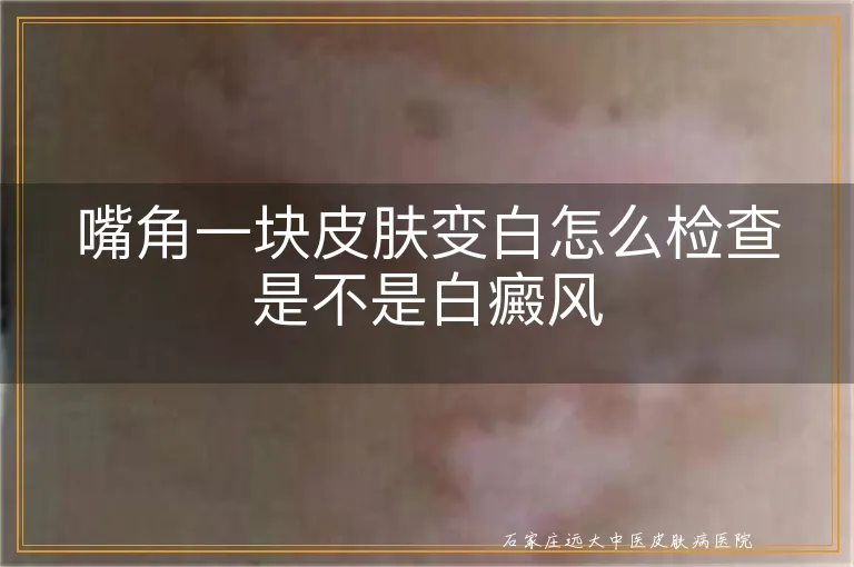 嘴角一块皮肤变白怎么检查是不是白癜风