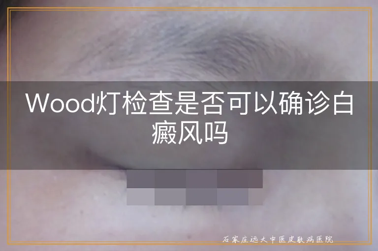 Wood灯检查是否可以确诊白癜风吗