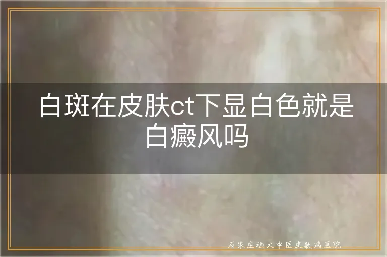 白斑在皮肤ct下显白色就是白癜风吗