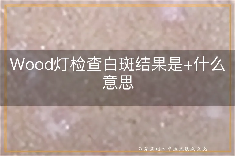 Wood灯检查白斑结果是+什么意思