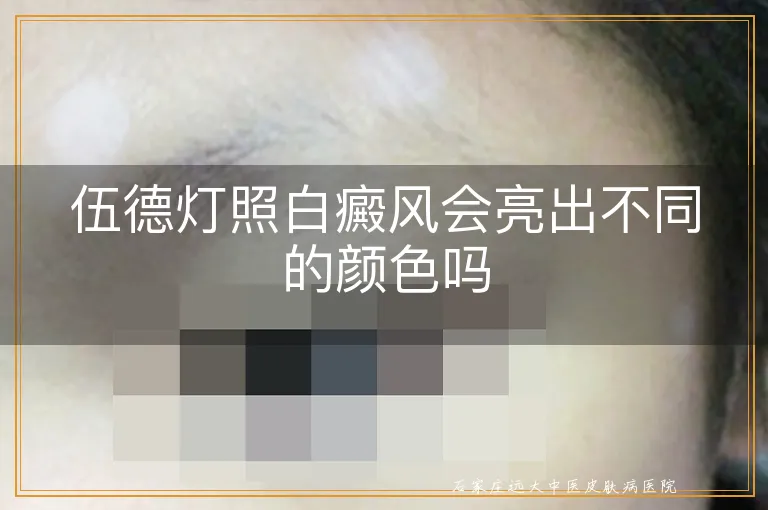 伍德灯照白癜风会亮出不同的颜色吗