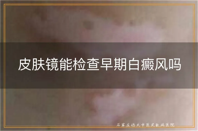 皮肤镜能检查早期白癜风吗