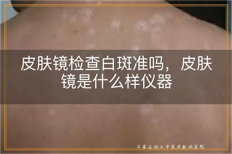 皮肤镜检查白斑准吗，皮肤镜是什么样仪器