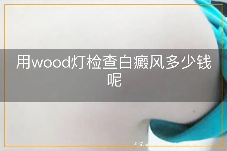 用wood灯检查白癜风多少钱呢