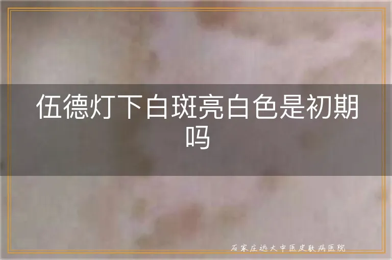 伍德灯下白斑亮白色是初期吗