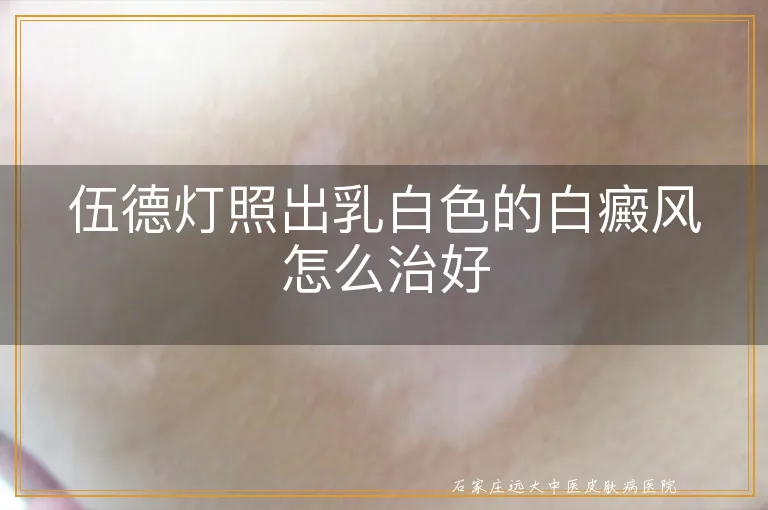 伍德灯照出乳白色的白癜风怎么治好