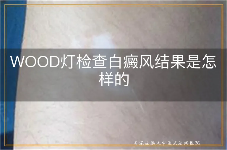 WOOD灯检查白癜风结果是怎样的