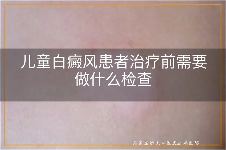 儿童白癜风患者治疗前需要做什么检查