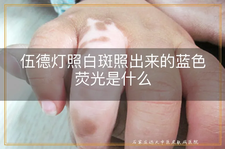 伍德灯照白斑照出来的蓝色荧光是什么