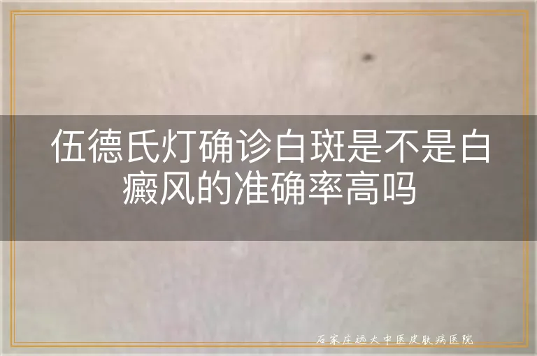 伍德氏灯确诊白斑是不是白癜风的准确率高吗