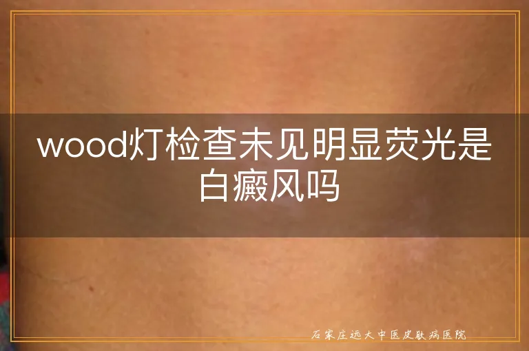 wood灯检查未见明显荧光是白癜风吗