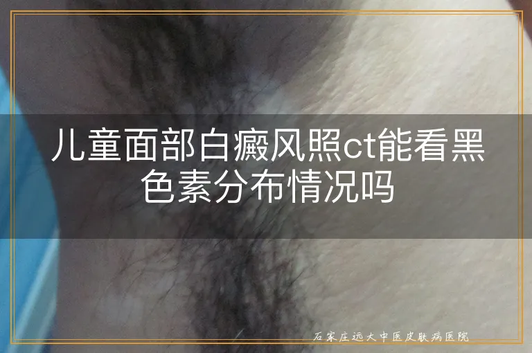 儿童面部白癜风照ct能看黑色素分布情况吗