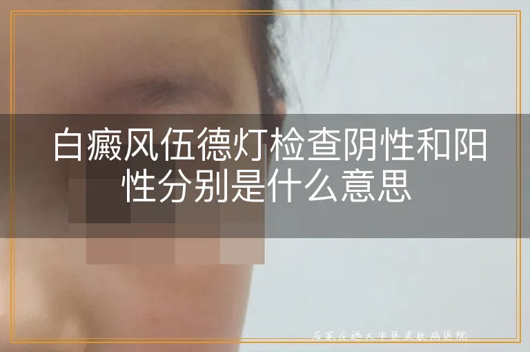 白癜风伍德灯检查阴性和阳性分别是什么意思