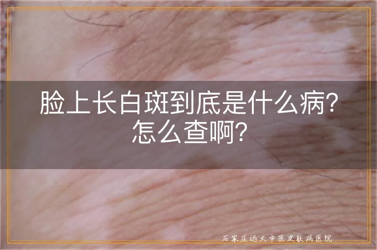 脸上长白斑到底是什么病？怎么查啊？