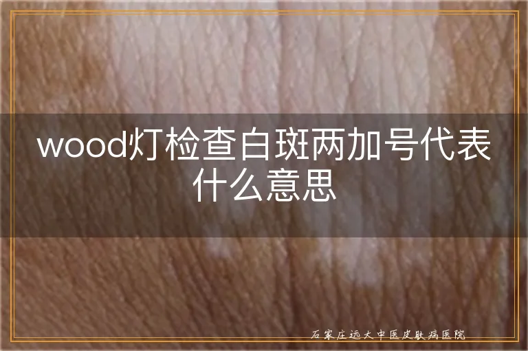 wood灯检查白斑两加号代表什么意思