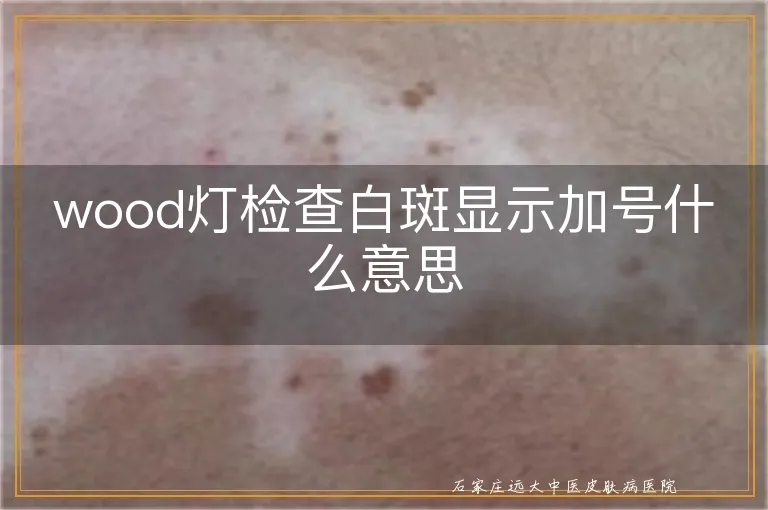 wood灯检查白斑显示加号什么意思