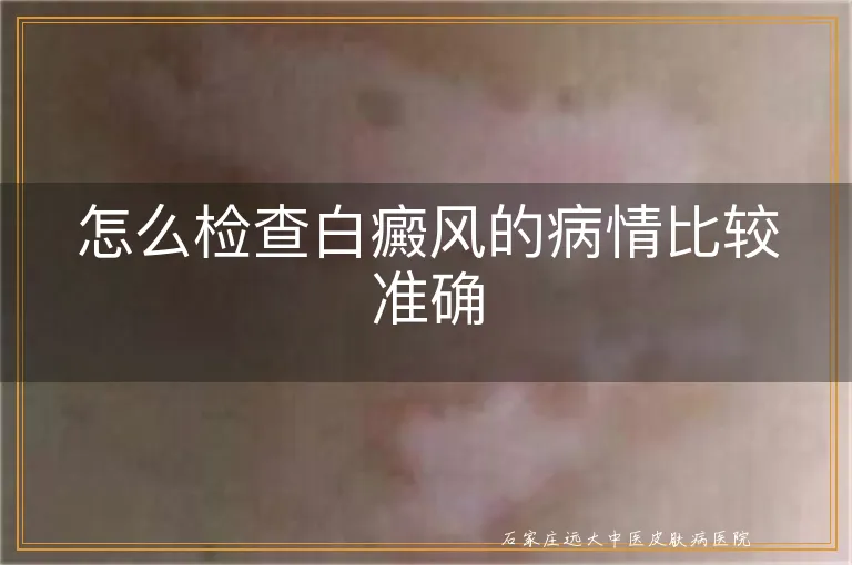 怎么检查白癜风的病情比较准确