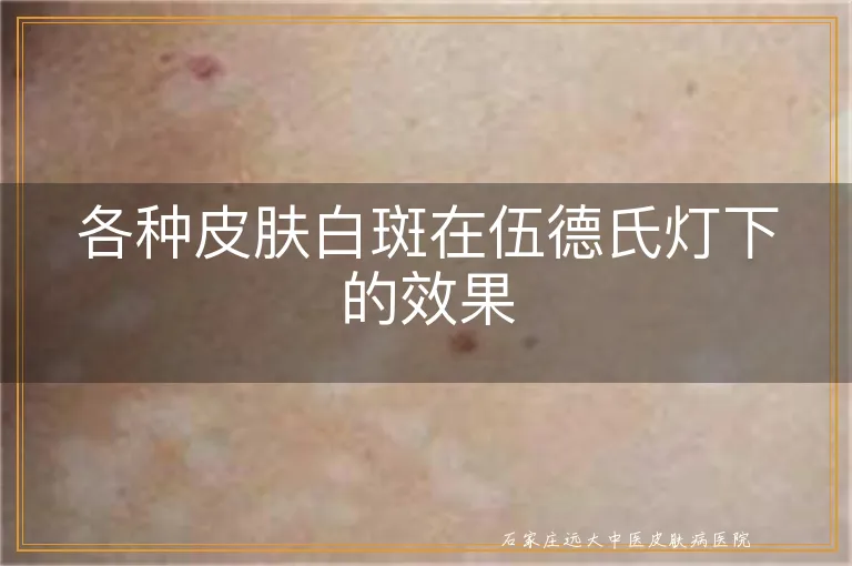 各种皮肤白斑在伍德氏灯下的效果