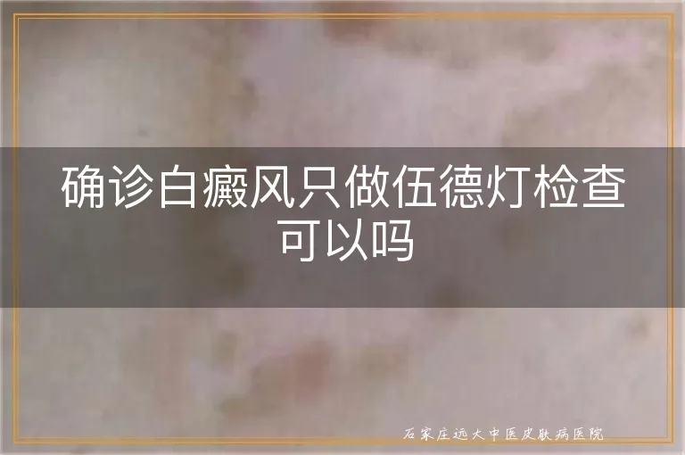 确诊白癜风只做伍德灯检查可以吗